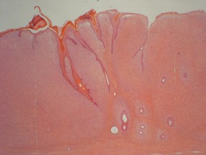 Photo 2 : Sarcoide équin (x10, H&E), prolifération fibroblastique tumorale dans le derme associée à une hyperplasie de l’épiderme sous forme de spicules.