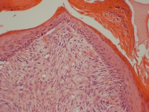 Photo 3 : Sarcoide équin (x100, H&E), les cellules tumorales sont alignées le long de l’épiderme