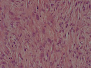 Photo 4 : Sarcoide équin (x400, H&E), faisceaux enchevêtrés de fibroblastes tumoraux.