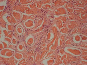 Photo 5 : Sarcoide équin (x100, H&E), les fibroblastes tumoraux infiltrent entre les fibres de collagène du derme.