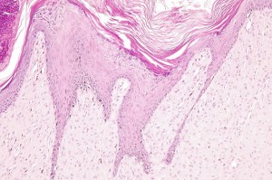 Photo 8 : Sarcoide félin (x100, H&E), les cellules tumorales sont alignées le long de l’épiderme hyperplasique et intimement associés à l'épiderme.