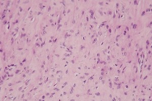 Photo 9 : Sarcoide félin (x400, H&E), les cellules tumorales sont des myofibroblastes agencés en faisceaux enchevêtrés.