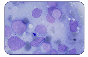 Cytologie : lymphome malin à lymphocytes granuleux (chat)