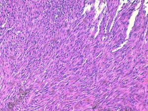 Photos 20 :  carcinome à cellules fusiformes, HE X 200 (photo LAPVSO).