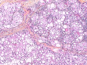 Photo 14 : carcinome riche en cellules lipidiques, HE X200 (photos LAPVSO).