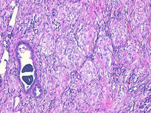 Photos 18 : carcinome et myoépithélioma malin, HE X200 (photos LAPVSO).