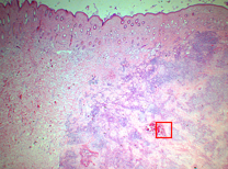 Photo 1 : Tissu cutané d’un cheval, HE X20 : à gauche le tissu sain et à droite plusieurs foyers coalescents granulomateux et éosinophiliques (le carré rouge matérialise le site de la photo 2)