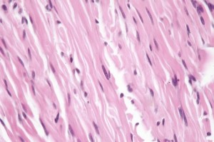  Fig 3 : Chien, STM sous-cutané, score de différenciation 1 : faisceaux entrelacés de cellules fusiformes entremêlés de fibres de collagène, suggérant un phénotype fibroblastique/fibrocytique avec une grande ressemblance avec le tissu adulte normal (HE X400)