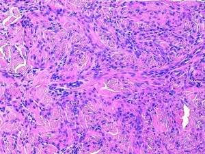 Fig 4 : Chien, STM sous-cutané, score de différenciation 2 : faisceaux entrelacés de cellules fusiformes entremêlés de fibres de collagène, suggérant un phénotype fibroblastique/fibrocytique mais la ressemblance avec le tissu adulte normal est moins nette (HE, X 200)