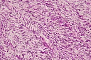 Fig 5 : Chien, STM sous-cutané, score de différenciation 3 : faisceaux entrelacés de cellules fusiformes selon un agencement en arêtes de poisson compatible avec un phénotype fibroblastique/fibrocytique mais la ressemblance avec le tissu adulte normal est absente et le type histologique ne peut être affirmé (HE, X400)