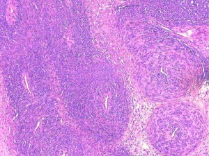 Fig 12 : Chien, STM sous-cutané, score de différenciation 2 : cellules fusiformes tourbillonnante périvasculaire en bulbe d’oignon compatible avec un phénotype périvasculaire pariétal ou périnerveux avec ressemblance moins évidente avec les tissus mous normaux périvasculaires ou périnerveux (périnèvre) (HE X100)