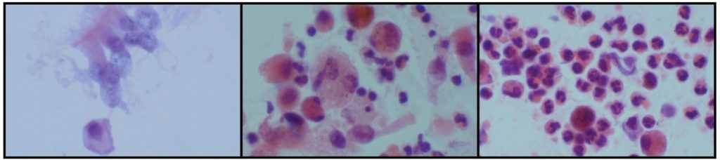 Photo 2 : Images microscopiques correspondant aux cytologies des lavages trachéaux équins précédents (x400 H&E). De gauche à droite : pas d’inflammation, inflammation neutrophilique modérée, inflammation neutrophilique marquée.