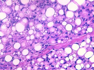 Fig 7 : Chien, STM sous-cutané, score de différenciation 2 : cellules rondes au cytoplasme ballonnisé compatible avec un phénotype lipoblastique/adipocytaire avec une ressemblance moins évidente avec un tissu adipeux adulte (HE X400)