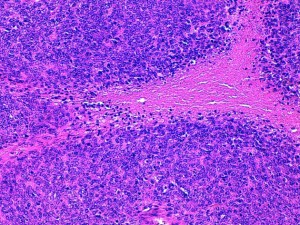 Fig 2 : Chien, STM sous-cutané, score de nécrose tumorale, un foyer de nécrose (HE X200)