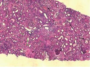 Photo 4 : Atteinte glomérulaire majeure avec fibrose segmentaire et adhérence à la capsule de Bowman (flèche noire), glomérulosclérose (tête de flèche) et protéinurie (flèche vertes)(photo Dr M. Fine).