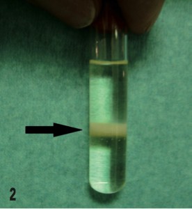 Nephropathietube