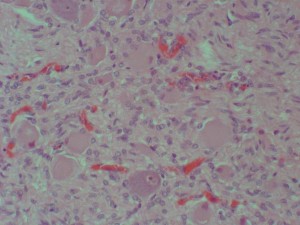 Dégénérescence extensive de neurones d’un ganglion cervical (Hémalun-éosine, x100). K. Withwell and C. Volmer, Animal Health Trust, Newmarket. 