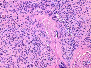 Fig 8 : Chien, STM sous-cutané, score de différenciation 1 : cellules fusiformes à disposition palissadique des noyaux et agencements neuroïdes suggérant avec un phénotype schwannien (gaine des nerfs périphérique) avec une grande ressemblance avec la gaine d’un nerf périphérique normal (HE x200)