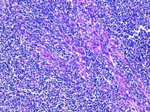 Fig 10 : Chien, STM sous-cutané, score de différenciation 3 : cellules fusiformes à disposition palissadique des noyaux compatible avec un phénotype schwannien (gaine des nerfs périphérique) mais sans vraie ressemblance avec la gaine d’un nerf périphérique normal et dont le type histologique précise ne peut être affirmé (HE x200)