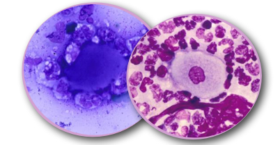 Cellules acantholytiques : image "en roue crantée", les granulocytes adhèrent à la cellule acantholysée