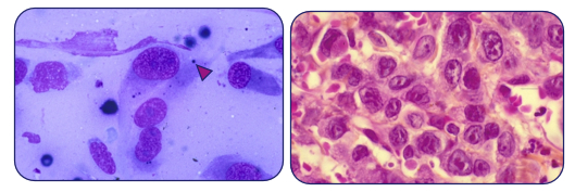 Cytologie : mélanocytes tumoraux pigmentés             Histologie : tumeur maligne anaplasique à cellules épithélioïdes