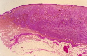 Mastocytome cutané dermique (HE x25)