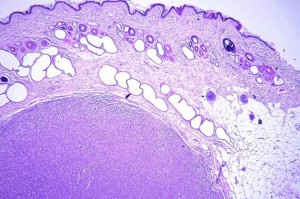 Mastocytome sous-cutané (HE x25)